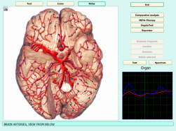 brain arteries
